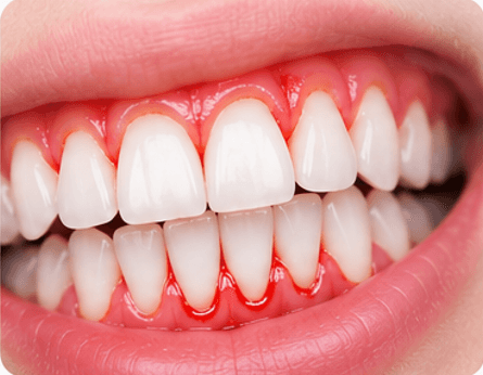 Bleeding Gums