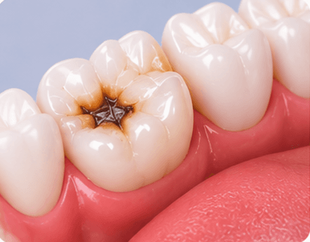 Cavities / Tooth Decay
