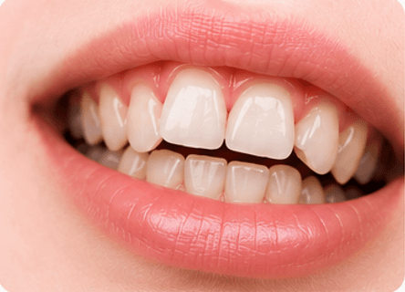 Misaligned teeth assessment before orthodontic treatment
