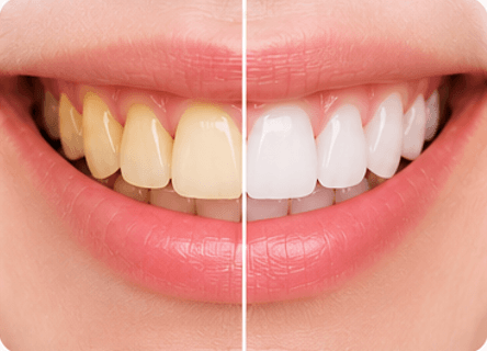Tooth stain assessment before professional whitening