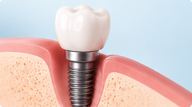 Dental Implants