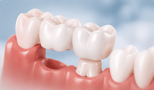 Dental Bridges