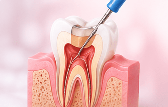 Root Canal Treatment