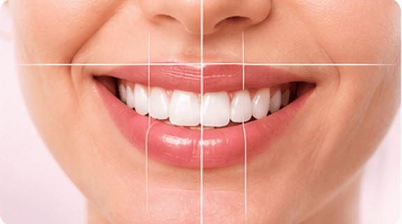 Smile Designing