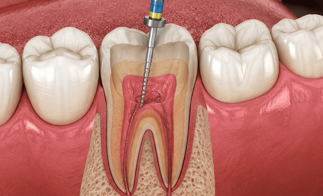 What Happens During a Root Canal Treatment?