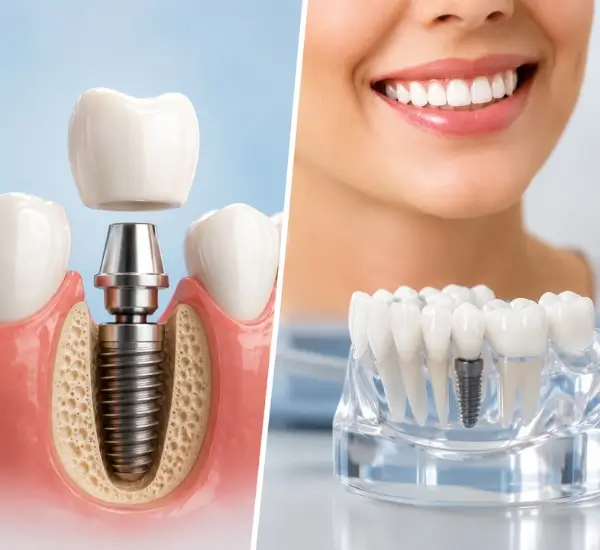 Dental Implants illustration