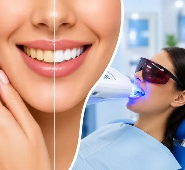 Teeth Whitening illustration